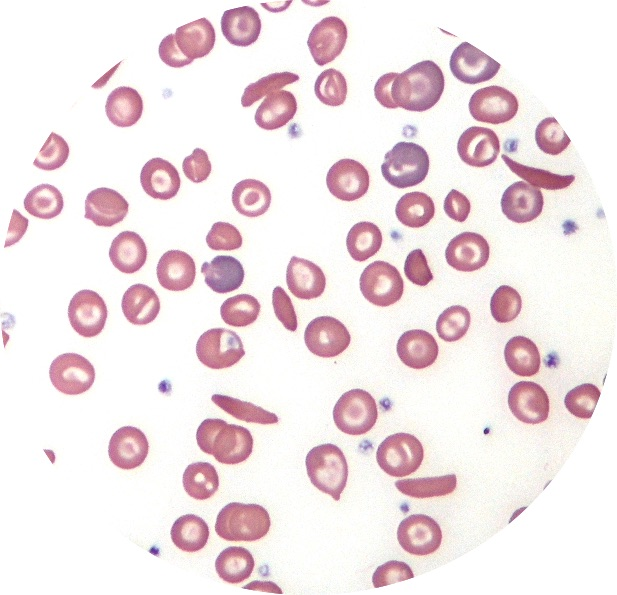 <p><span><strong>Identify the blood disorder you are viewing on the slide.&nbsp;</strong></span></p>