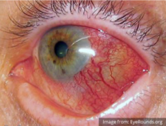 <p>inflammation of the sclera</p>