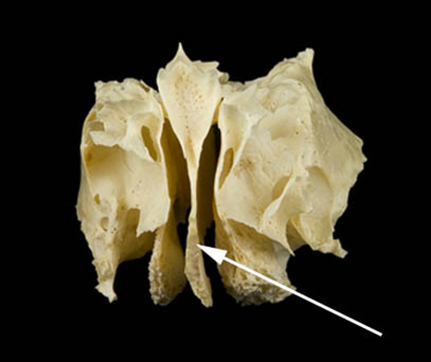 <p>What boney feature is this?</p>