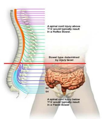 <ul><li><p>Decreased GI motility- Injury at T6 and ^, decreased GI motility, NG tube for intermittent suction</p></li><li><p>Stress ulcer prophylaxis- 6-14 day ^ risk, test stool and NGT drainage for blood, Monitor labs for decreased HCT, H2 blockers/ PPIs</p></li><li><p>Neurogenic bowel- reflex emptying occurs, bowel program</p></li></ul><p></p>