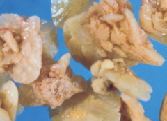 <p>Which type of canine calculi is seen in this image that is more common in dogs and commonly seen with other diseases?</p>