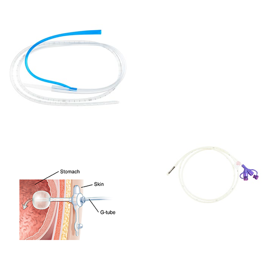 <p>Inserted through the nose into the stomach for short-term decompression, feeding, or med delivery </p>