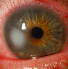 <p>Can be bacterial, viral, fungal, or parasitic.</p><p>•S. pneumoniae and S. aureus</p><p>•Contact lens users can develop Pseudomonas infection</p><p>•Herpes simplex 1 and Herpes zoster viruses common in US</p>
