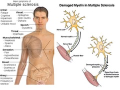 <p>multiple sclerosis</p>