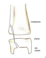 <p>A fracture involving all 3 elements of the bone → the Physis, Epiphysis & Metaphysis:</p><p>- Similar to Type III (also an intra-articular fracture) → can result in chronic disability</p><p>- Also creates the "Thurston Holland Corner Sign". Small corner of bone in metaphysis. Type II and IV.</p><p>Interferes with the growing layer of cartilage cells → often causes premature fusion of the involved bone → leads to deformity (essentially stops bone growth)</p>