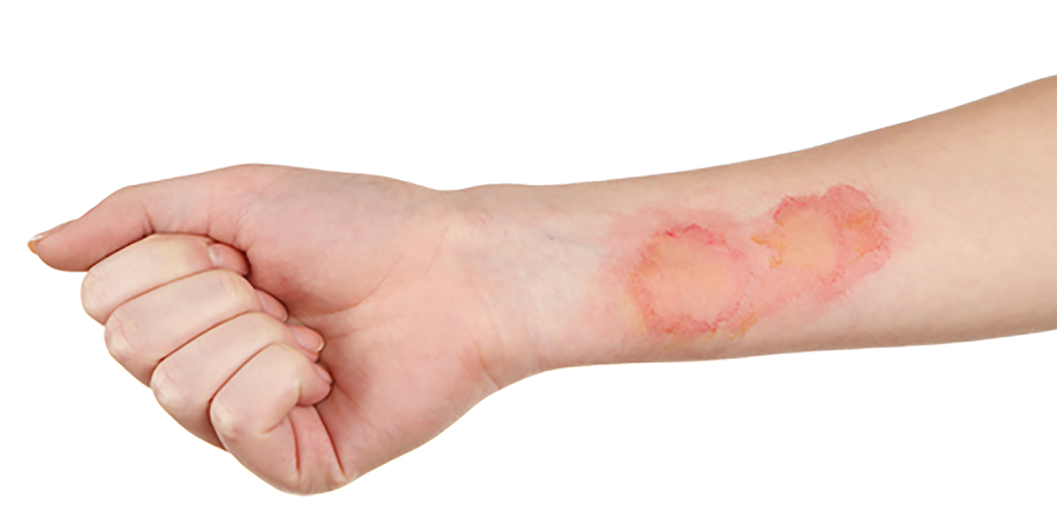 <p>mild burn</p>