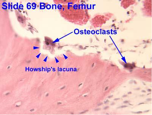 <p>CASE: A patient taking a bisphosphonate asks how the drug increases bone density. Which bone cell is primarily inhibited, and why can the drug remain clinically relevant long after the medication is stopped?</p>