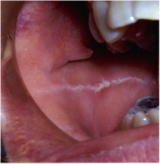 <p>white line that extends Anterio-posteriorly on the buccal mucosa along the occlusal plane. May be bilateral. More prominent in patients with bruxism or clenching habit.</p>