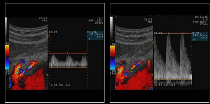 <p>Mesenteric doppler with NPO patient. The IMA was evaluated and had monophasic, high resistance waveform with a peak velocity of 150 cm/s. What do the findings indicate?</p>