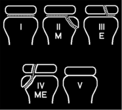 <p>define a salter harris type IV fracture</p>