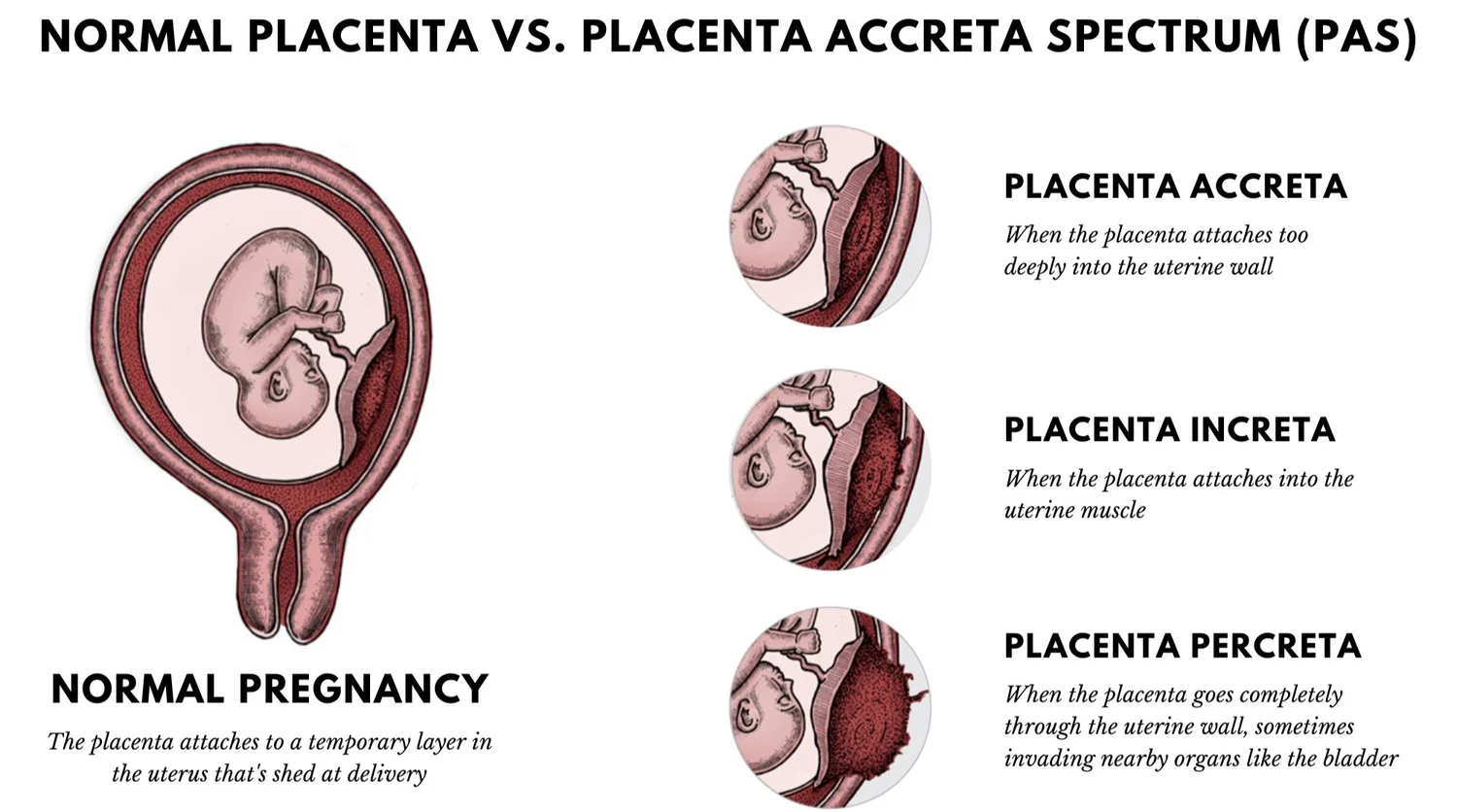 <p>Perforation of myometrium, uterine serosa, & involves adjacent organs</p>