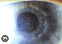 <p>- Occurrence: 2-5 days</p><p>- Cause: diffuse inflammatory infiltrates across periphery of interface, not penetrating the stroma or extending into the flap which will increase to cover the flap inter face and a central haze develops (looks like staining but epi intact)</p><p>- RF:</p><p>- Tx: topical steroids, possible lifting of flap with debridement of interface</p>