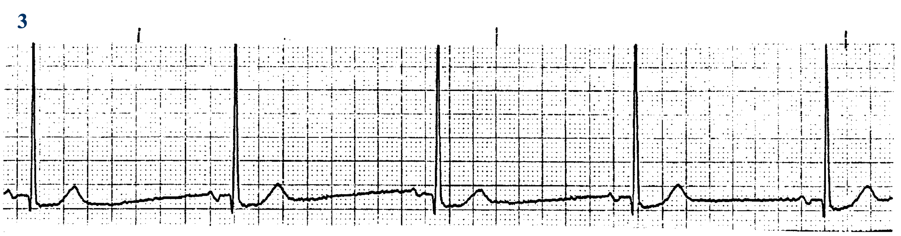 <p>What ECG is this? </p>