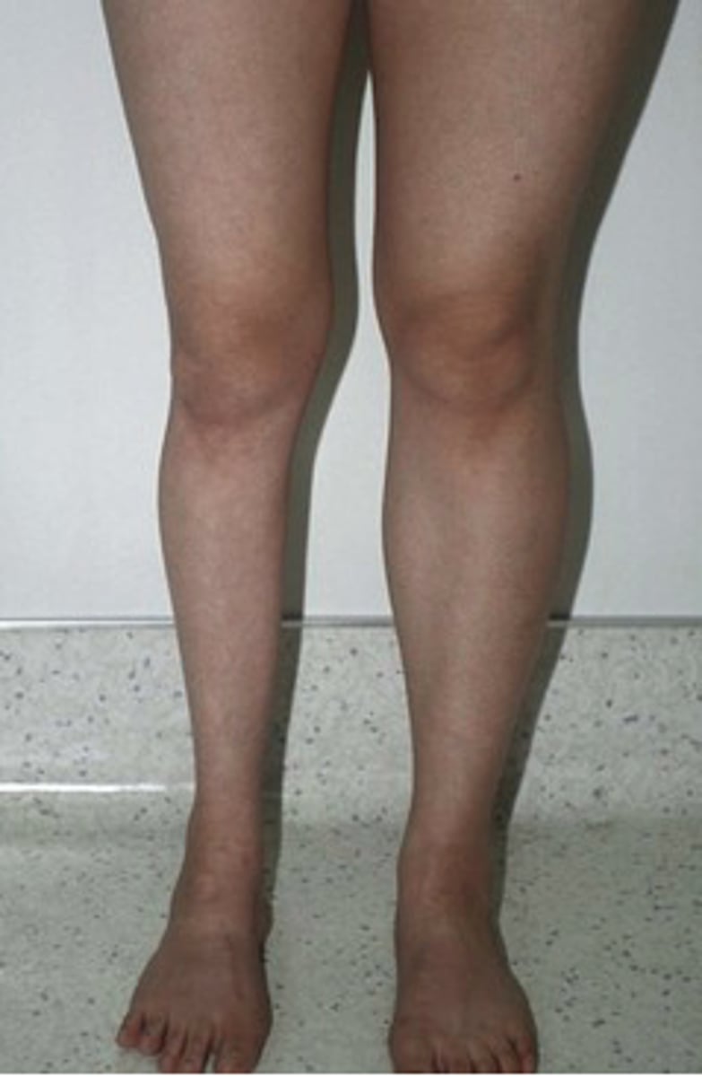 <p>wasting of muscles</p><p>may result from primary disorder of the muscle, from a lesion on the nerve that supplies it, or limb immbolization</p>