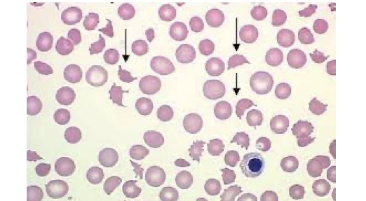 <p>What is MAHA (microangiopathic hemolytic anemia )</p>