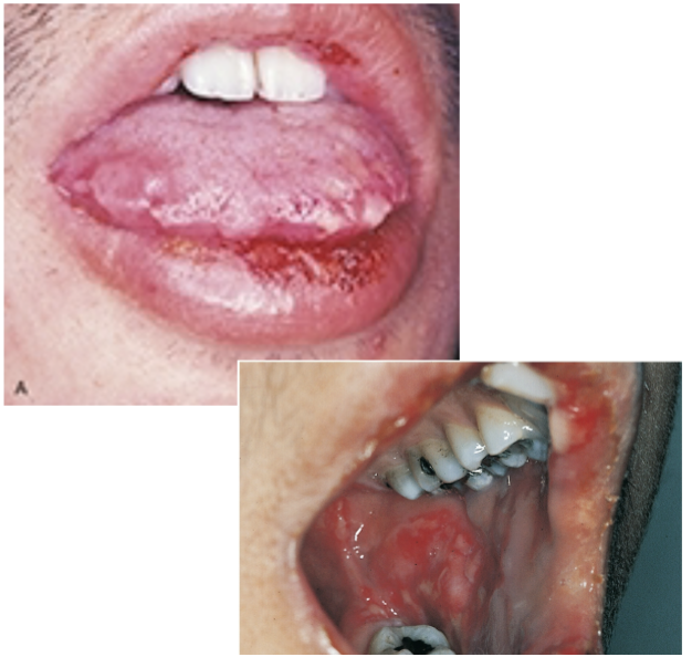<p>Erythema Multiforme “crusty lips &amp; oral ulcerations”</p>