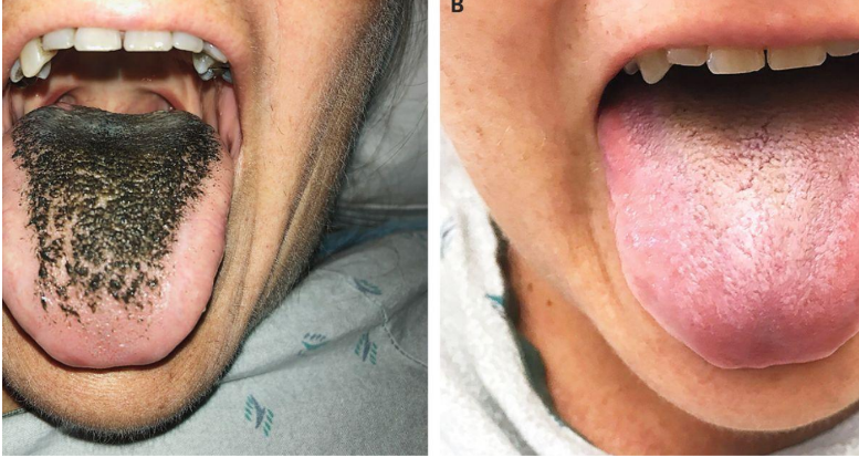 <p>happens if no hygiene </p>