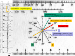 <p>1. novad - 0</p><p>2. novad - +60</p><p>3. novad - +120</p><p>no augšas uz leju pieraksta</p><p>- ir izoelektriskais komplekss (R=S)</p><p>= sirds ass perpendikulāra otrajam novadījumam</p><p>- 1. novadījumā QRS ir pozitīvs - tātad vektors iet uz to virzienu, kur ir 1. novadījums </p><p>- 3. novad. ir negatīvs - tātad elektriskā aktivitāte dodas pretējā virzienā</p><p>sirds ass ir -30</p>