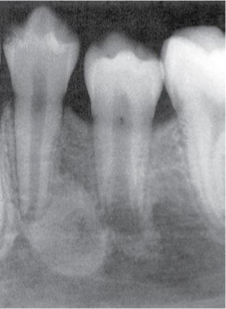 <p>What do you call this? <span>A <strong>change in the bone near the apices of teeth</strong></span></p>