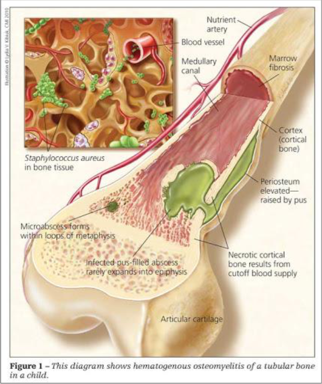 <p>Inflammatory or Infectious Disease</p>