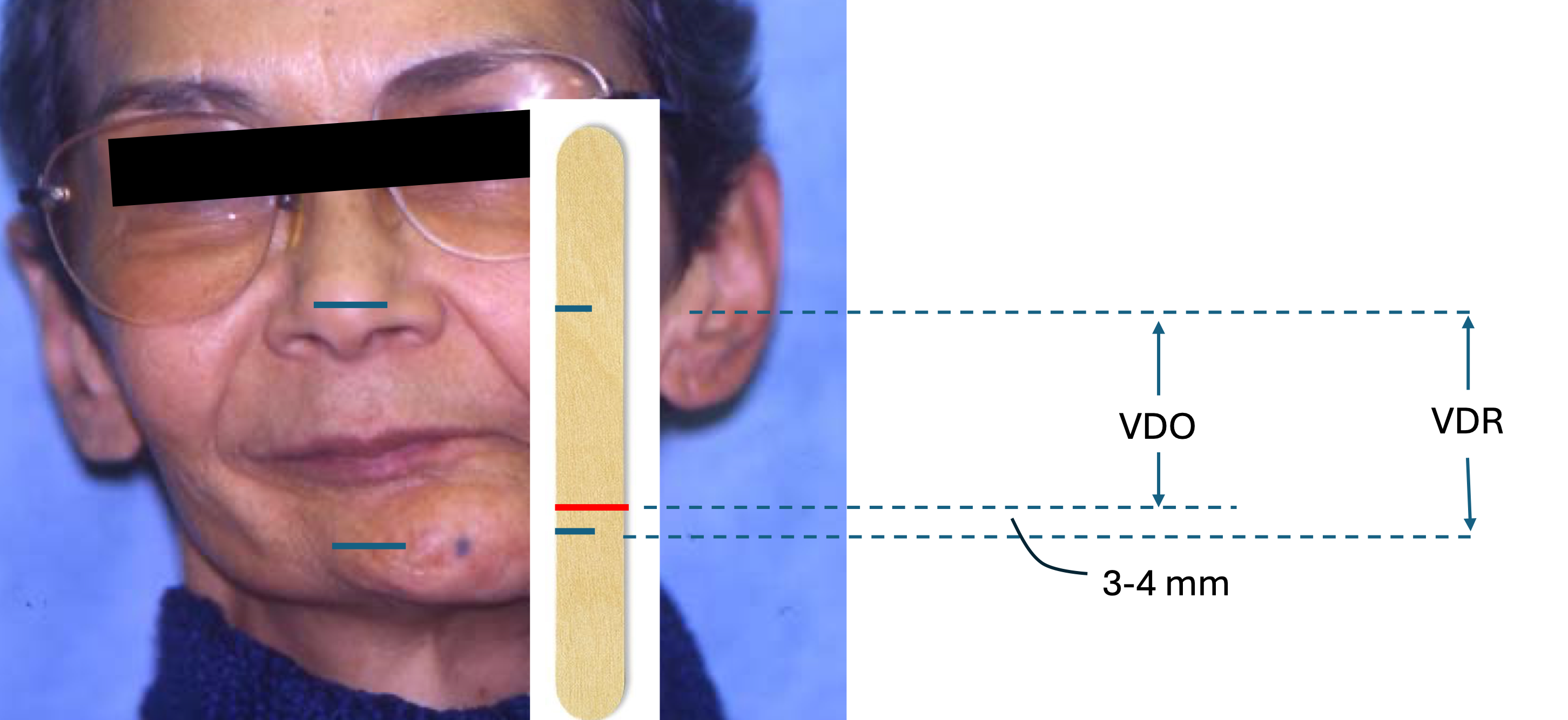 <p>tip of nose and chin</p>