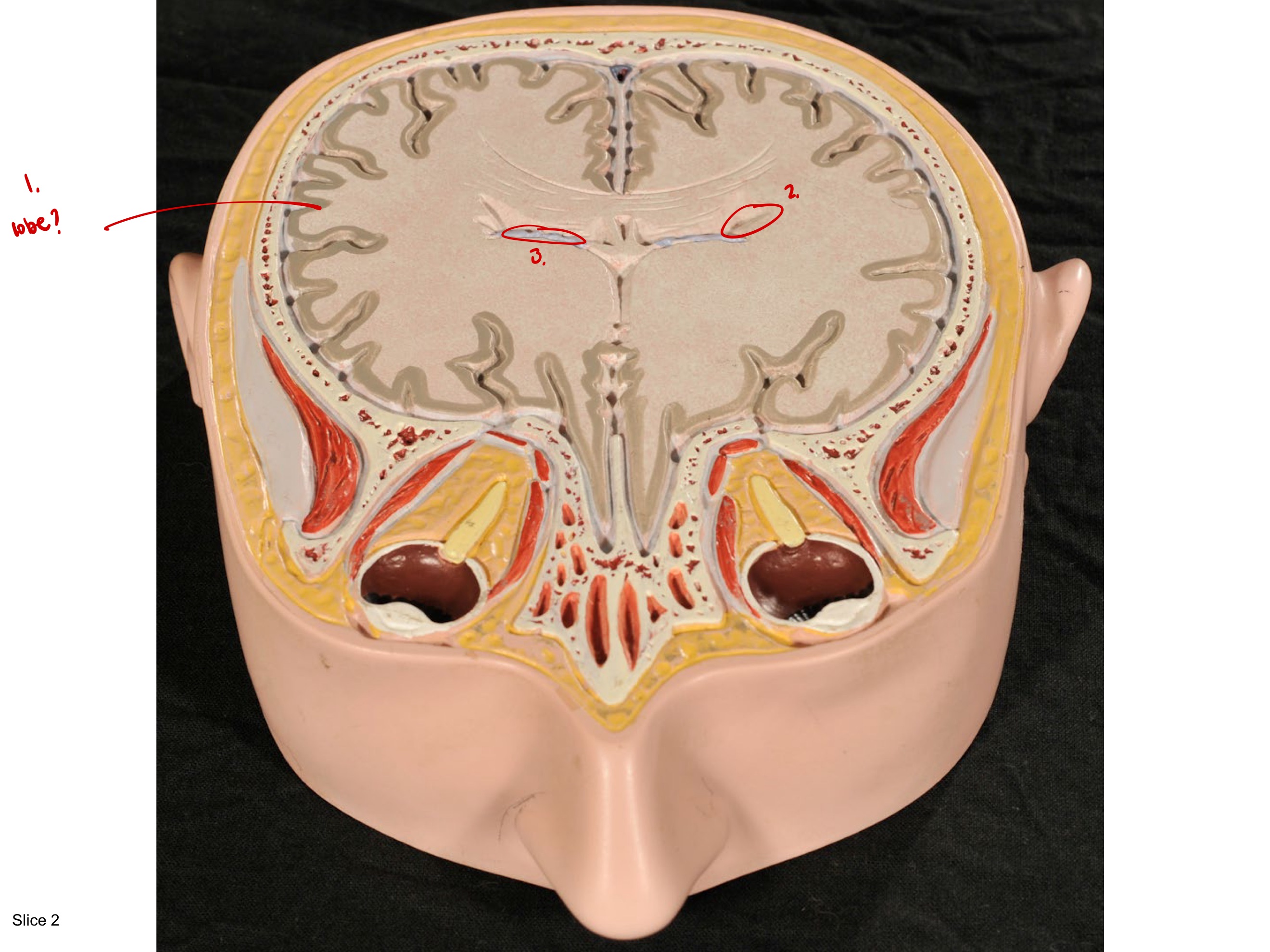 <p>Space under is 3rd ventricle </p>