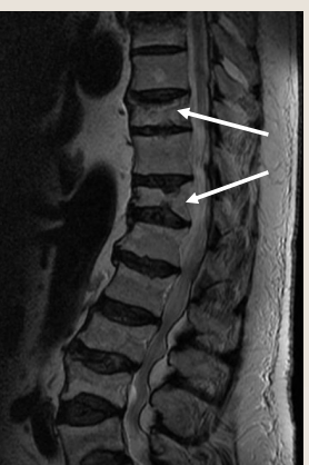 <p>what type of fracture is this</p>