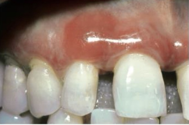 <p>Gingival erythema, desquamation, severe ulceration of free + inserted gum</p><p>Diffuse inflammation reaching mucogingival line</p><p>Range from burning sensation to severe pain</p><p>Usually dermatological origin </p>
