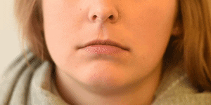 <p>Lower Lip Depressor</p>
