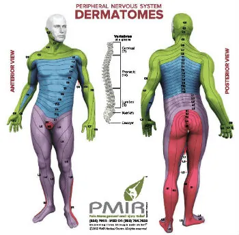 <p>It refers to the distribution of the herpes zoster rash along specific nerve pathways, affecting a single dermatome. </p>