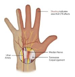 <p>nerve entrapment of median nerve </p>