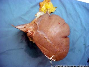 <p>what part of the coronary ligament of the liver is being highlighted?</p>