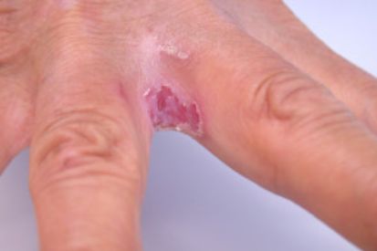 <p>Overgrowth of Candida yeast on warm, moist skin, often in areas such as the groin, armpits, or under breasts. </p>