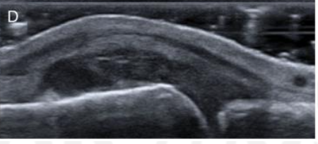 <p>Grade this synovial hypertrophy</p>