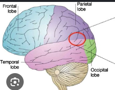 <p>A lesion in the right tempoparietal area </p>