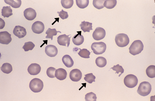 <p>ACANTHOCYTES</p>