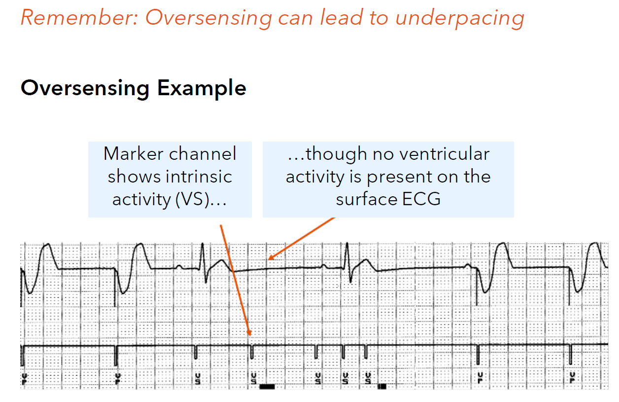 <p>an electrical signal other than an intrinsic cardiac depolarization is detected</p><p>Oversensing may inappropriately withhold pacing due to oversensing-induced inhibition</p>