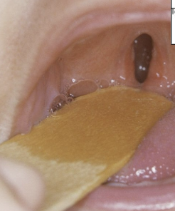 <p>failure of the palatal shelves to fuse </p>