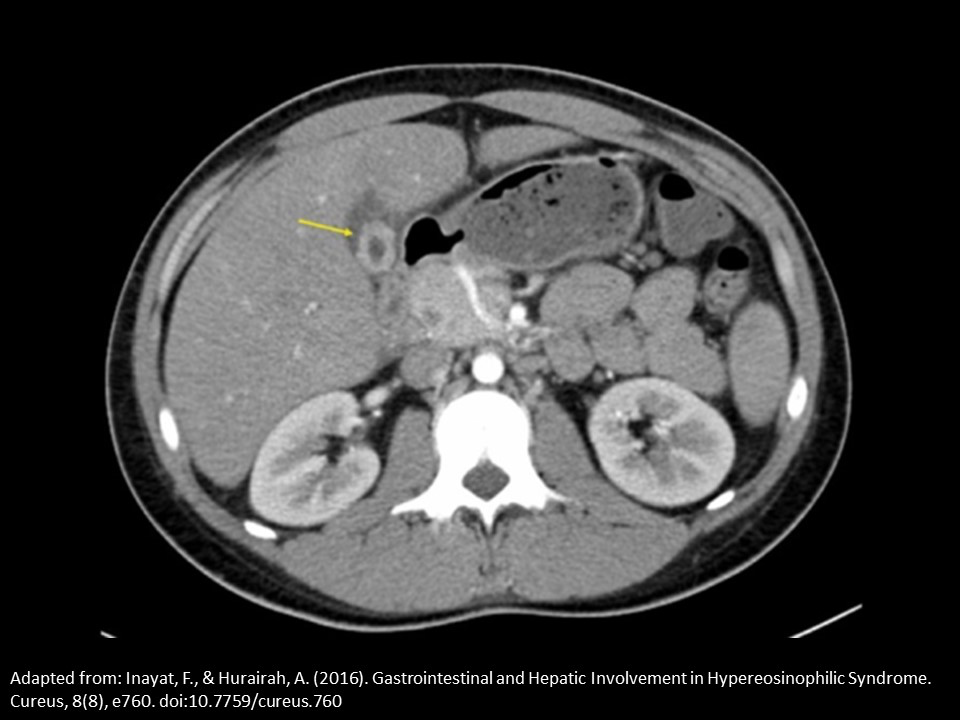 <p>A patient is referred for an abdominal ultrasound due to an abnormal CT scan. The yellow arrow indicates the gallbladder. Based on the single CT image, which of the following is expected finding on the ultrasound evaluation.</p>