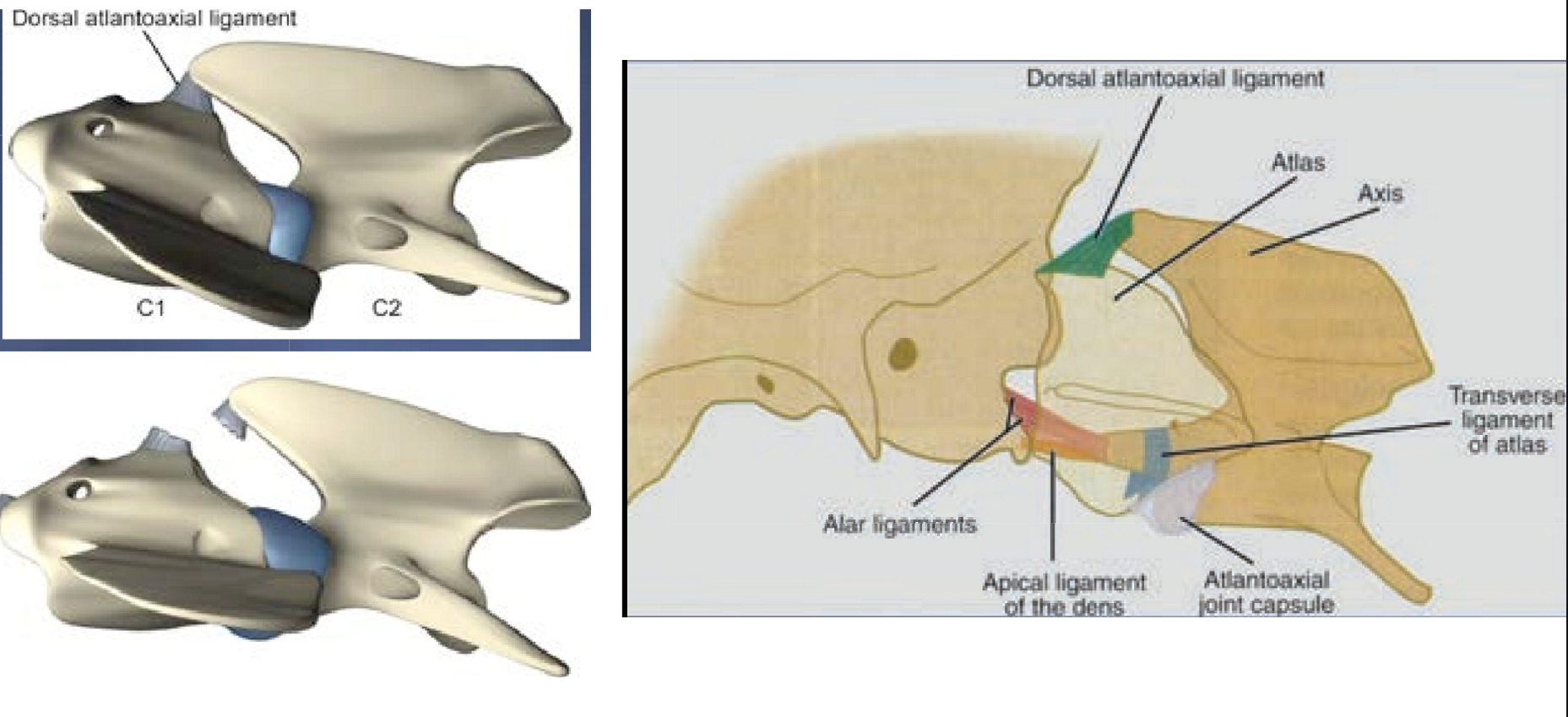 <p>1: there’s no IVD between C1-2 so jt is supported by 4 ligaments → 3 of them (apical, alar, transverse) are diretly attached to the dens (AKA odonotoid process)</p><ul><li><p><em>so, if smth happens to the dens, the jt loses 75% of its support…</em></p></li></ul><p>.</p><p>2: failure of the struc support ligs or processes in the C1-C2 region leading to subluxation</p><p>.</p><p>3: congenital = pt born w/ absent dens (aplasia), small dens (hypoplasia), or absent ligs</p><p>acq = trauma causes dens fracture or lig rupture </p>