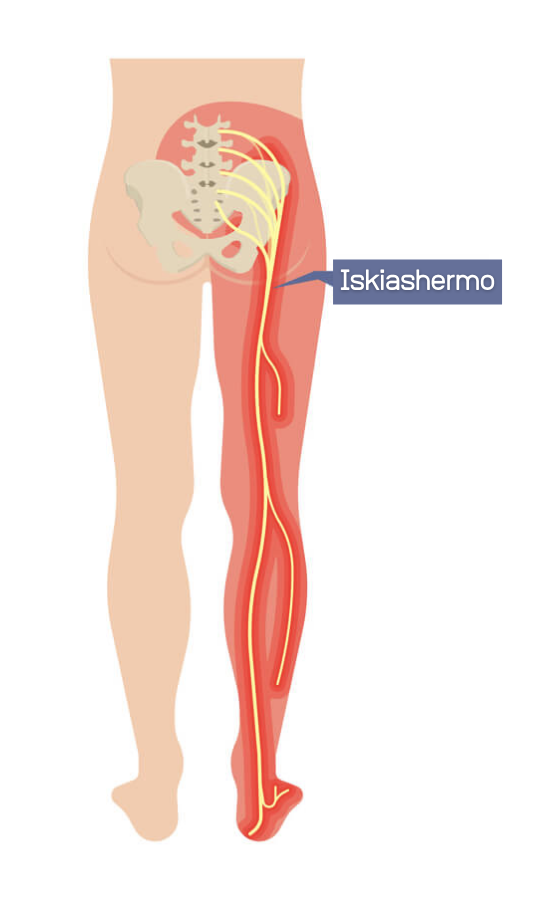<p>Kehon pisin ja paksuin hermo.<br>Kulkee alaselästä pakaran kautta reiden takaosaan ja sääreen.</p>