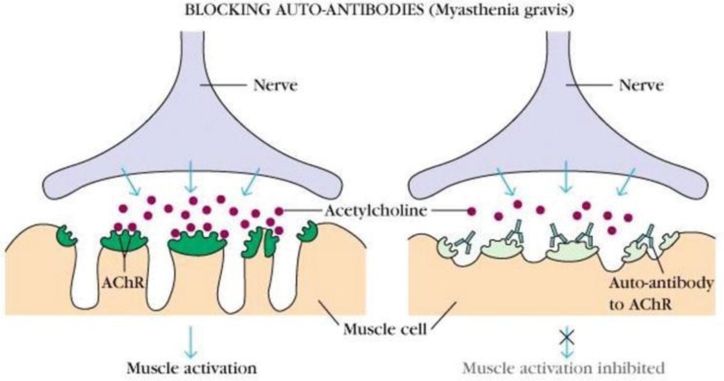 <p>An autoimmune disease characterized by grave muscle wasting due to antibodies attaching to muscle receptors for acetylcholine.</p>