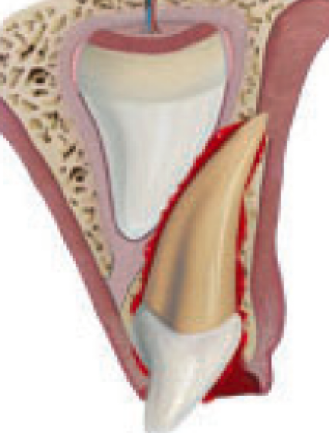 <p>Tooth displaced through buccal plate </p><p>Treatment:</p><ul><li><p>Radiographic evaluation according to the location of displacement of the tooth  it can appear shorter or longer</p></li><li><p>If apex displaced through buccal bone plate OR If apex is displaced into the developing tooth: allow spontaneous repositioning (takes up to 6 months)</p></li></ul><p></p>