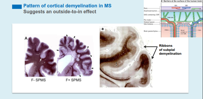 <p>Cortical demyelination commonly presents as ribbon-like subpial lesions in the outer cortical layers, closely associated with inflamed meninges and following gyri and sulci, suggesting an “outside-to-in” disease process.</p>