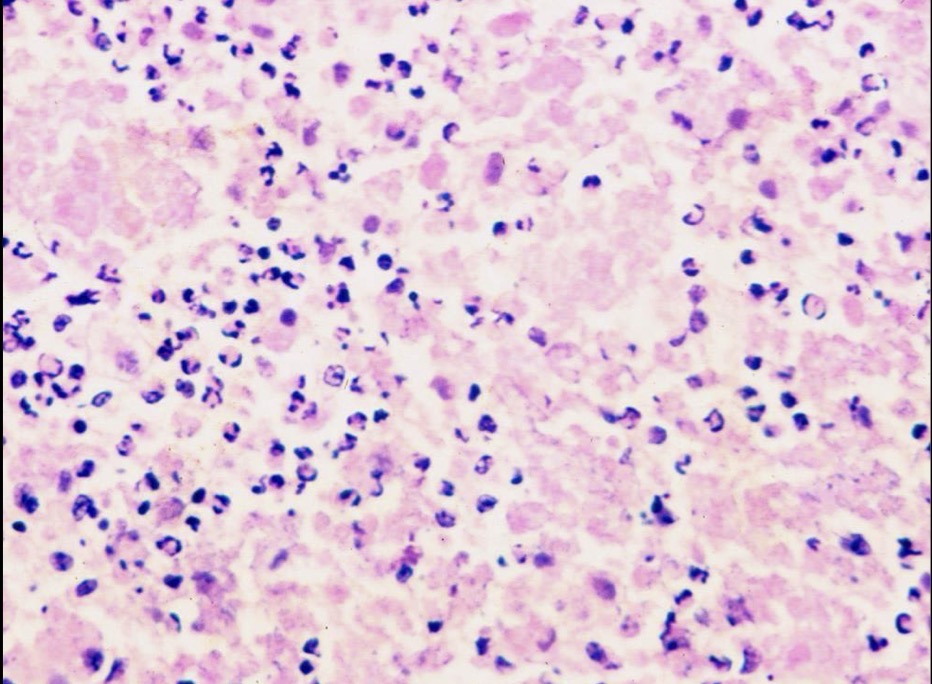 <p>what type of necrosis has this tissue undergone</p>