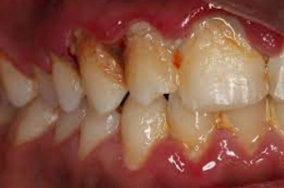 <p>bacterial infection causing painful, necrotic ulcers with a punched-out appearance.</p>