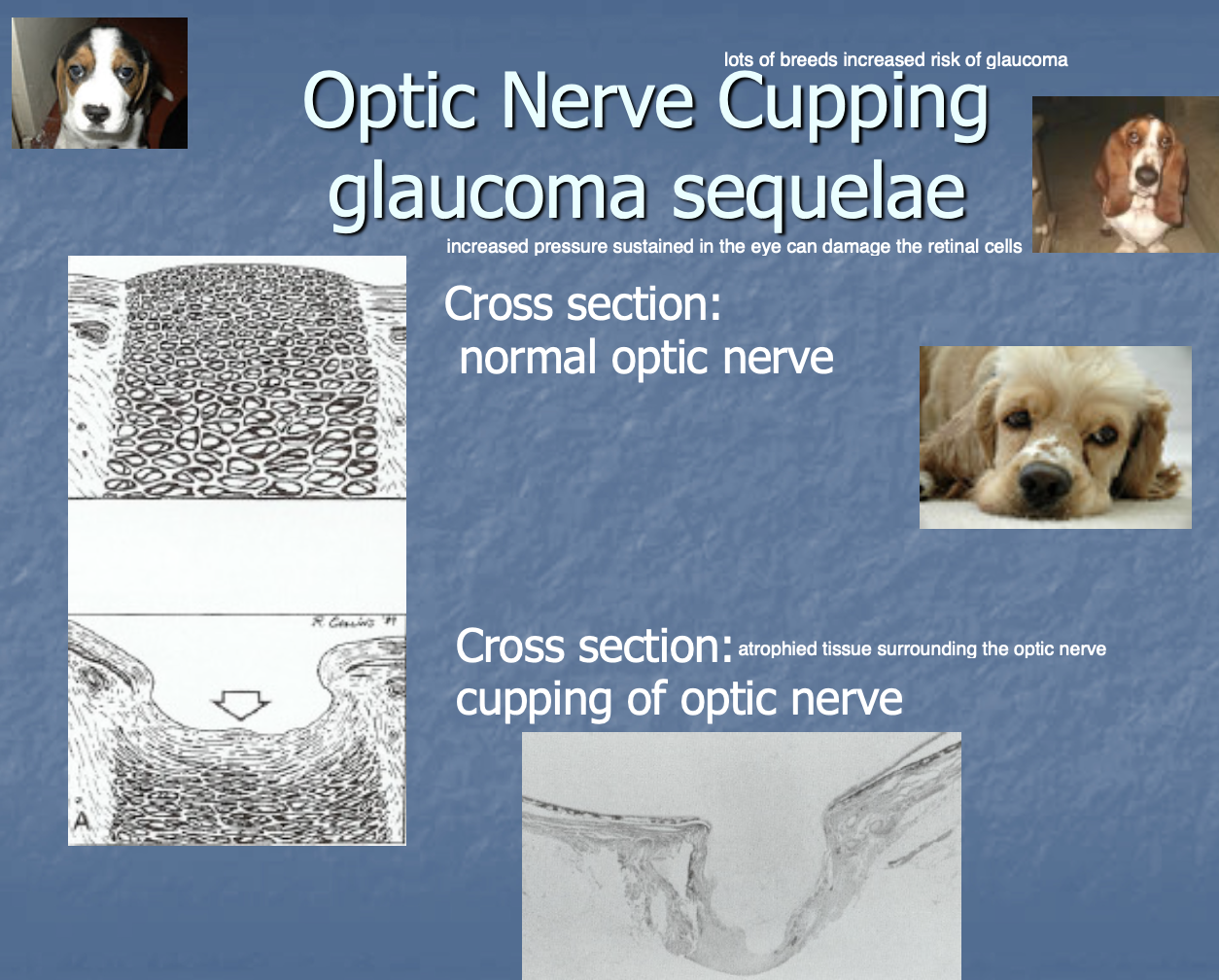 <p>as a sequellae to glaucoma (inc IOP can damage retinal cells)</p>