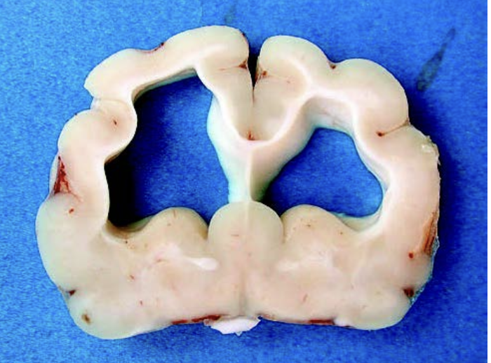 <p><span><strong>Du obducerar en äldre katt som uppvisat sjukdomstecken från storhjärnan. Ett av dina obduktionsfynd syns på</strong></span></p><p class="MsoNormal"><span><strong>bilden nedan.</strong></span></p><p class="MsoNormal"><span><strong>b)</strong> Förklara principiellt hur denna typ av förändringen uppstår i dess förvärvade form, och ge ett exempel på en</span></p><p class="MsoNormal"><span>bakomliggande orsak. <strong>(2p)</strong></span></p><p class="MsoNormal"><span>&nbsp;</span></p>