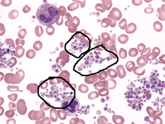 <p>- Thrombocytosis bc/ spleen fails to remove them</p>