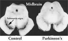 <p>Progressive disorder from dopamine depletion in substantia nigra.</p>